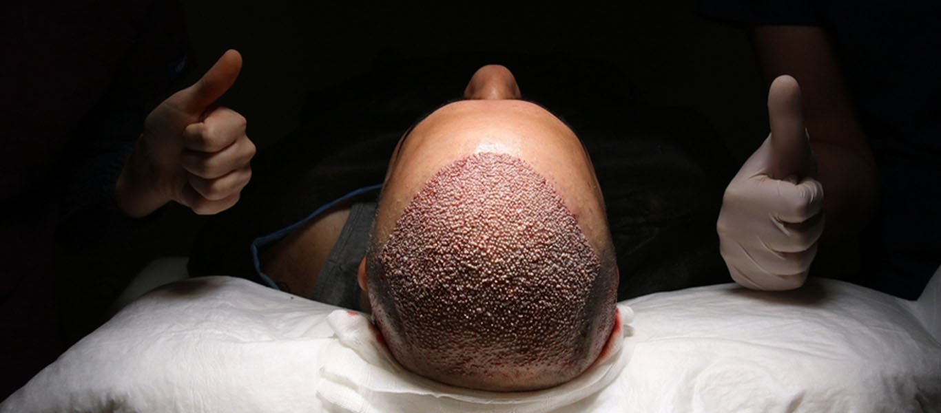 Hair Transplant in Islam