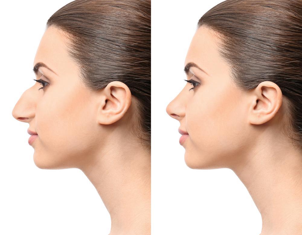 RHINOPLASTY(NOSE JOB)