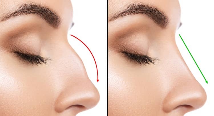 Rhinoplasty in Dubai