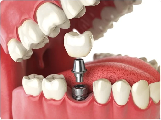 Dental implant