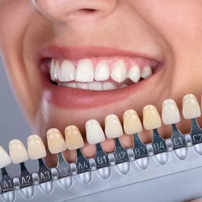 Dental veneers in Dubai 2