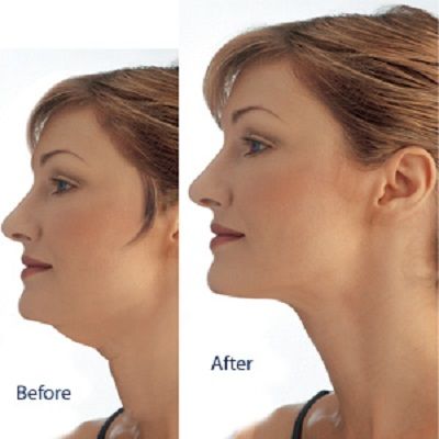 Double-Chin-Liposuction-in-Islamabad-Rawalpindi-Pakistan