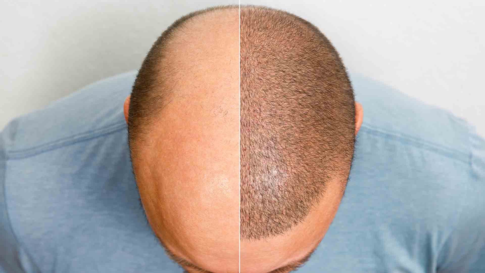 Hair-Transplant