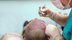 Hair transplant