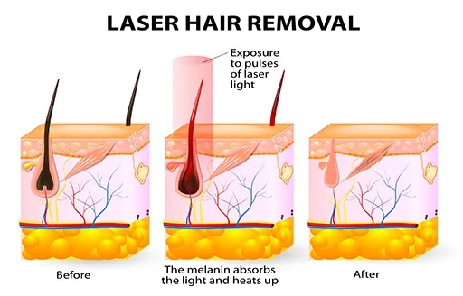 laser hair removal procedure in India