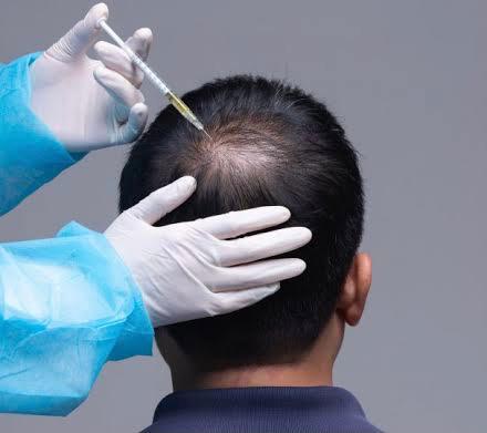 PRP-Hair-Loss-treatment-injectipon