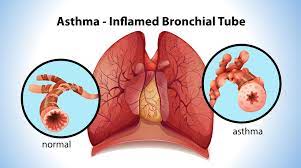 Severe Asthma