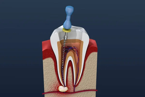 depositphotos_262169354-stock-photo-root-canal-treatment-process-illustration (1)