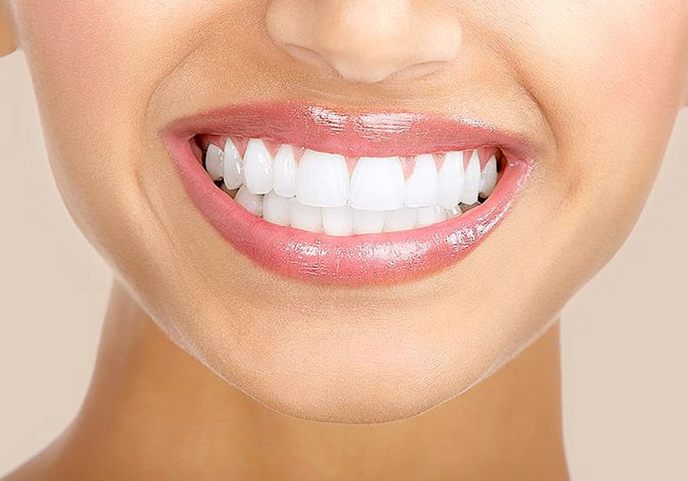 teeth-whitening (1)