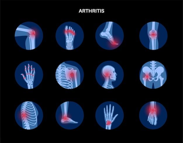 Premium Vector _ Rheumatoid arthritis, pain, bone disease concept_