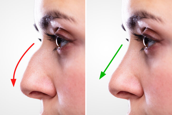 Rhinoplasty Nose Reshaping in Islamabad 1