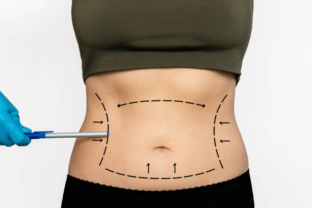 Liposuction (2)