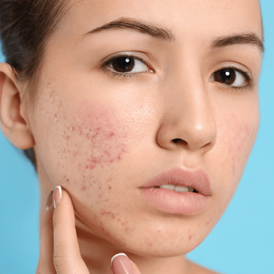 Actinic Keratosis Treatment in Dubai and Abu Dhabi