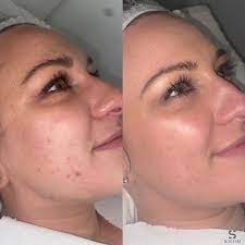 Actinic Keratosis Treatment in Dubai.