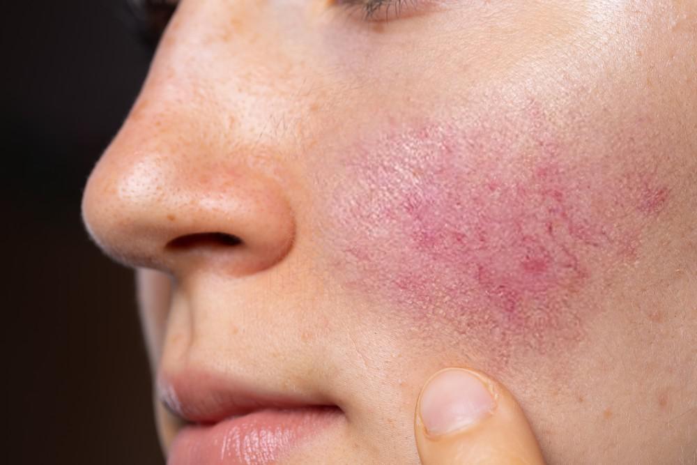 Cost of Rosacea Treatment in Riyadh