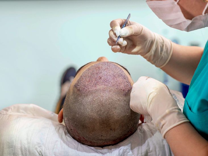 FUE Hair Transplant (2)