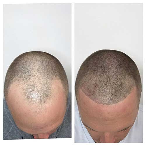 Hair-Thinning-Treatment-Vadodara