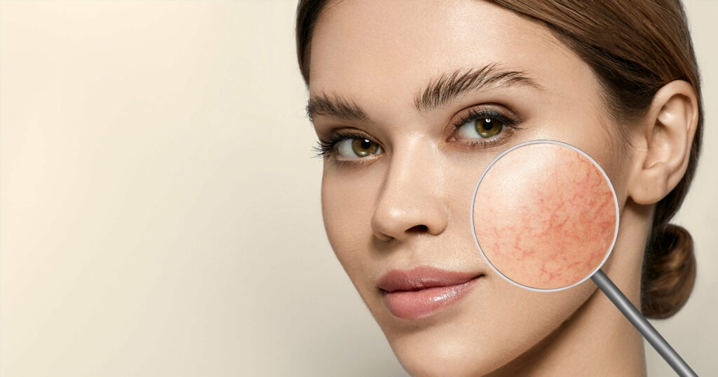 Sensitive-Skin-Rosacea-Understanding-Causes-Symptoms-and-Treatment-Options-scaled-1024x538