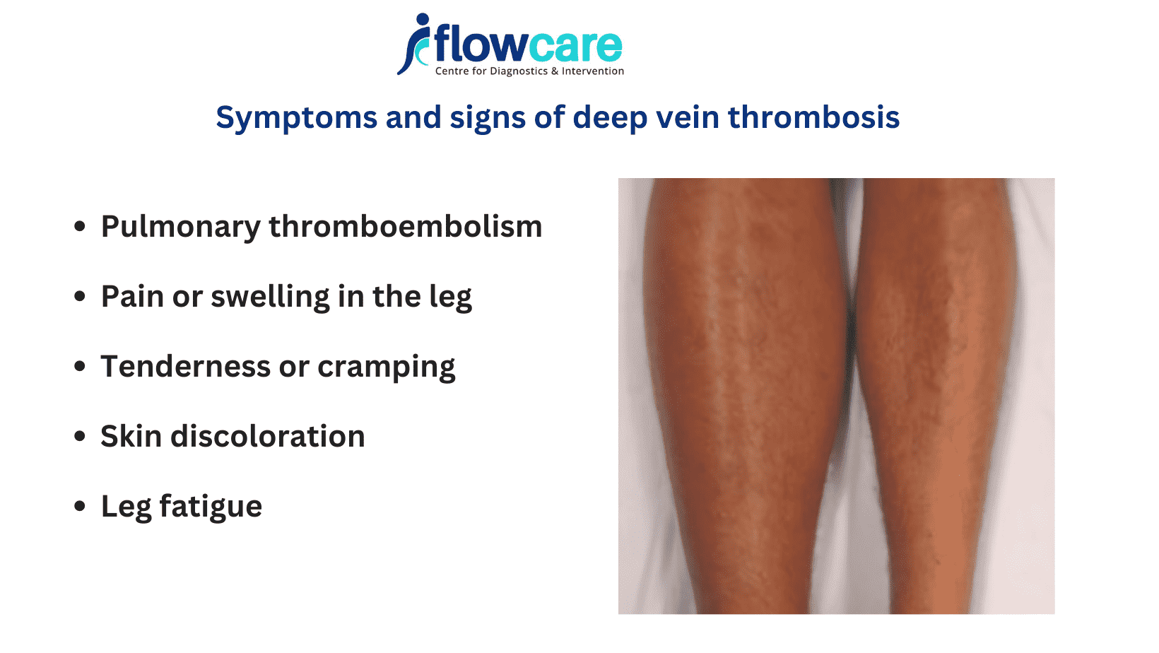 deep vein thrombosis1 (1)