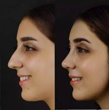 rhinoplasty in dubai