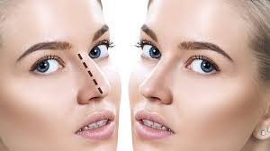 rhinoplasty