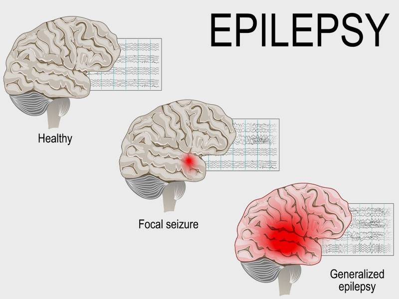 Epilepsy: Treatment by Pregabalin 150mg