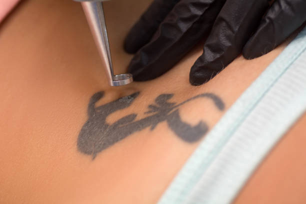 Laser tattoo Removal