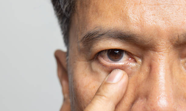 blepharoplasty